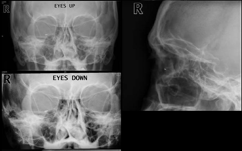 TheBlindSide RCEMLearning India
