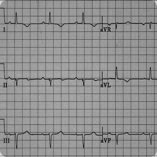 Transient Chest Pain RCEMLearning India