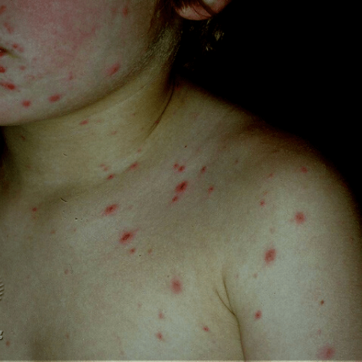 chicken pox RCEMLearning India