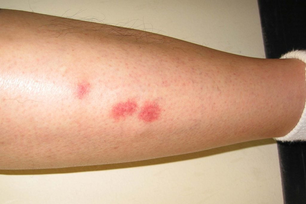 Homemade face mask What Do Bed Bug Bites Look Like?