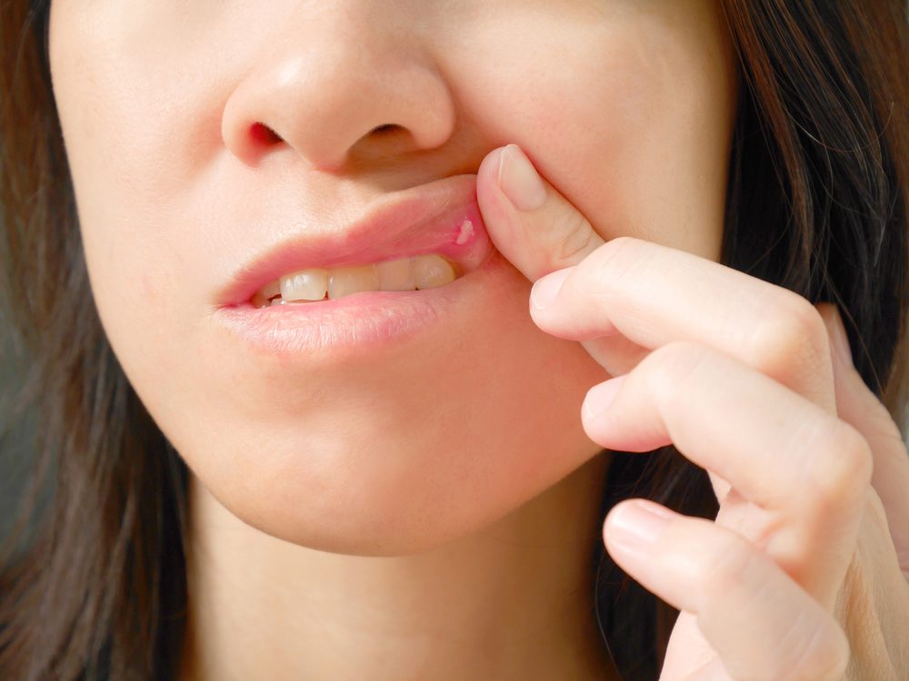 Canker Sore Home Remedies 13 Treatments That Cure Reader&#039,s Digest