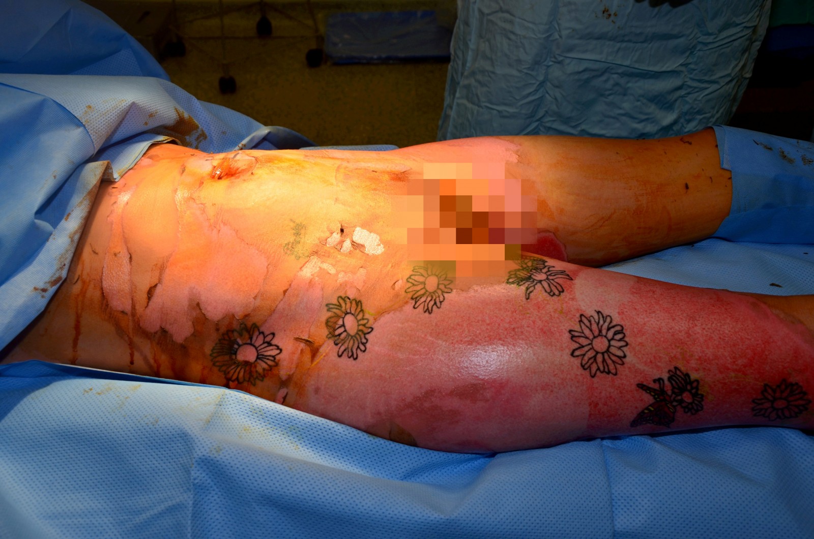 Brave mum bares scars after evil boyfriend poured boiling KETTLE of