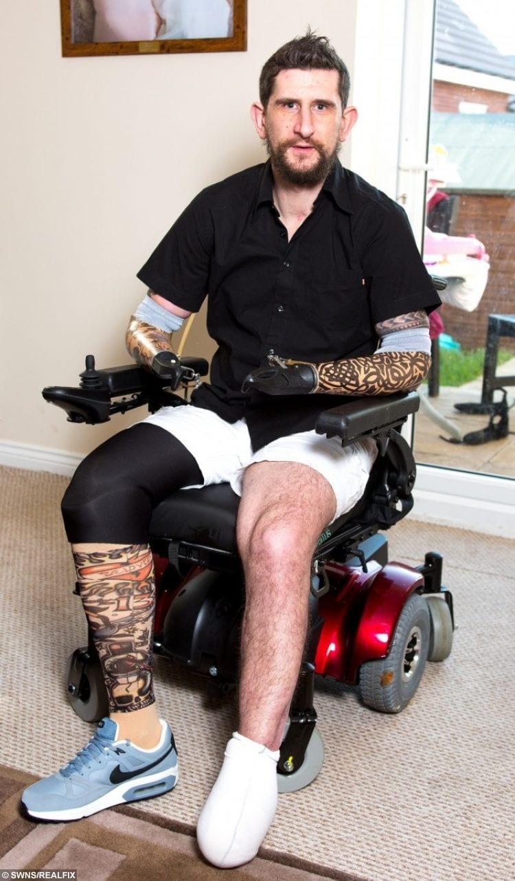 Scaffolder Who Lost Three Limbs In Electric Shock Horror Accident Now