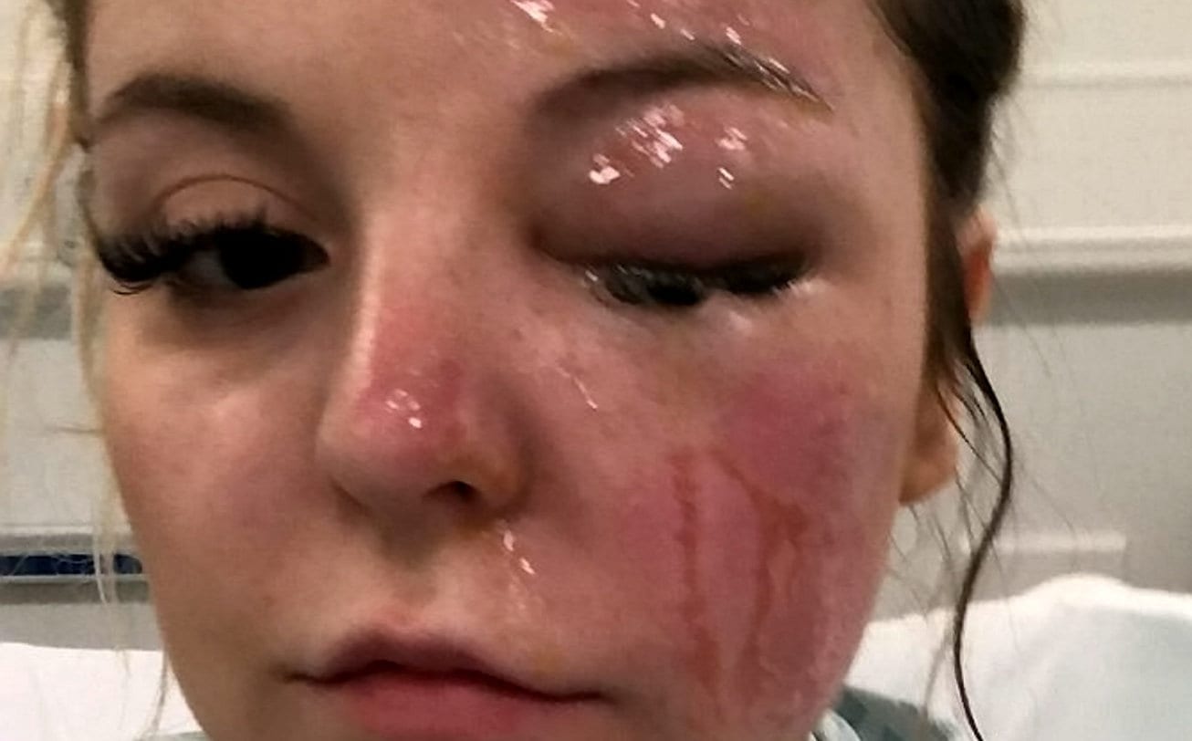 Woman Said She Was Nearly Blinded In One Eye And Suffered Horrific