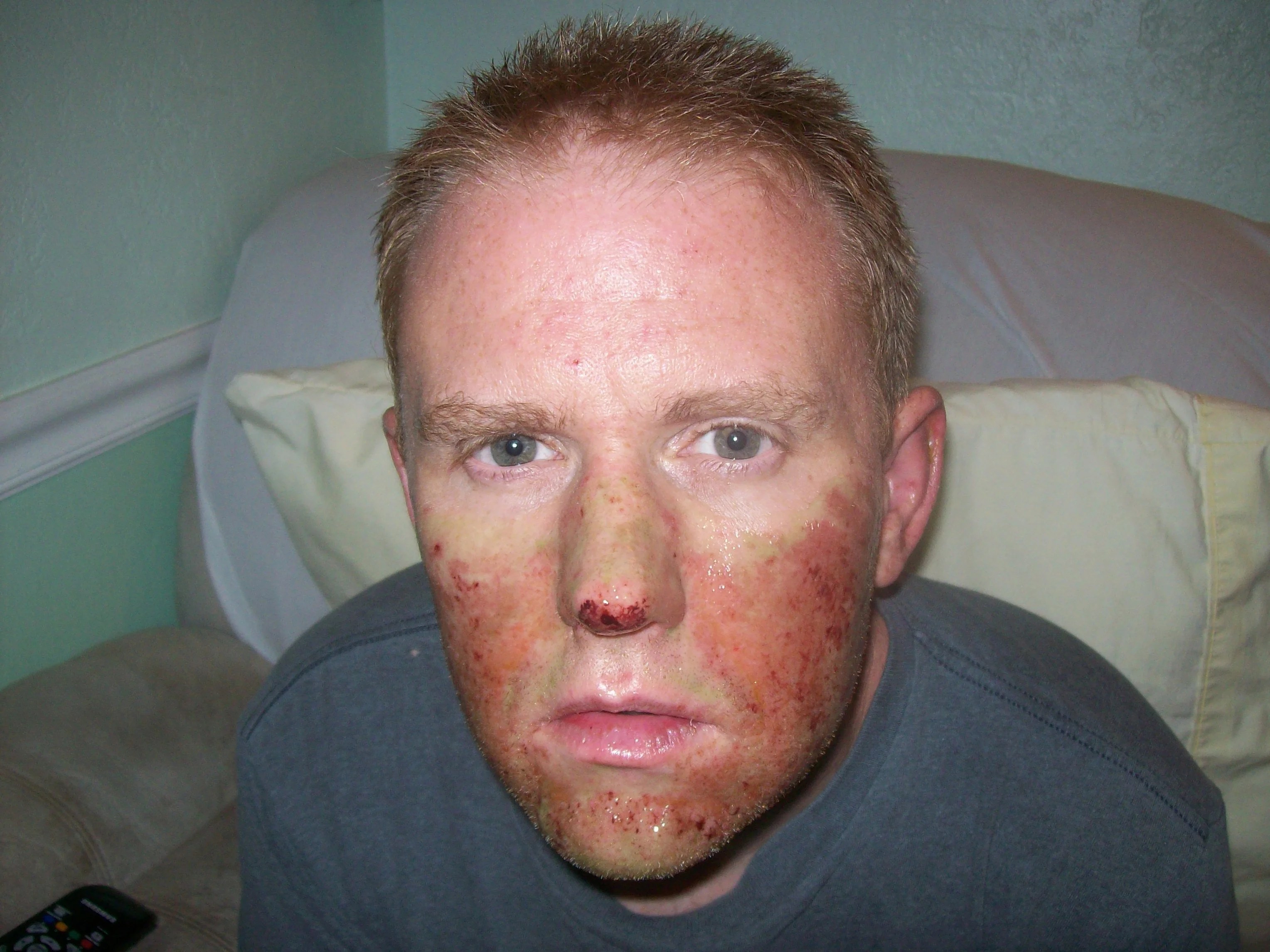 Chemical Burn On Face Pictures to Pin on Pinterest PinsDaddy