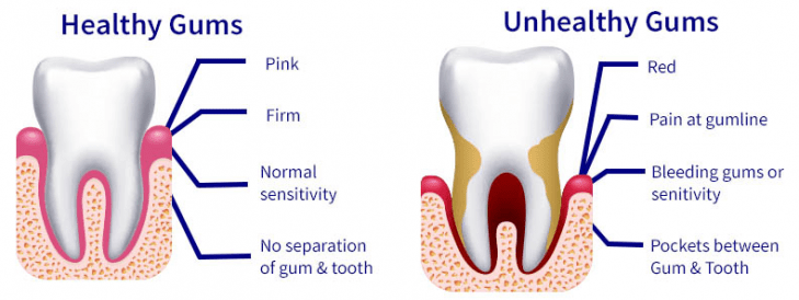 Prevent Receding Gums Archives Receding Gums
