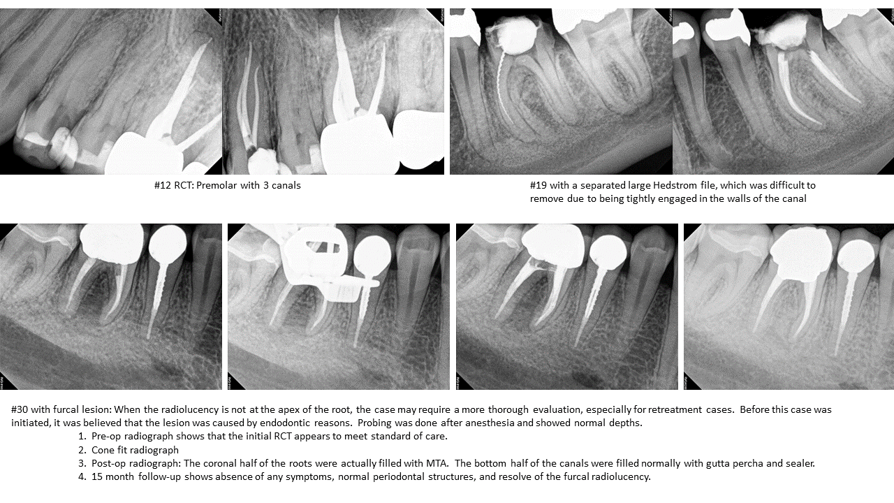 Dr. Kim's Case Studies Las Vegas NV, Red Rock Endodontics