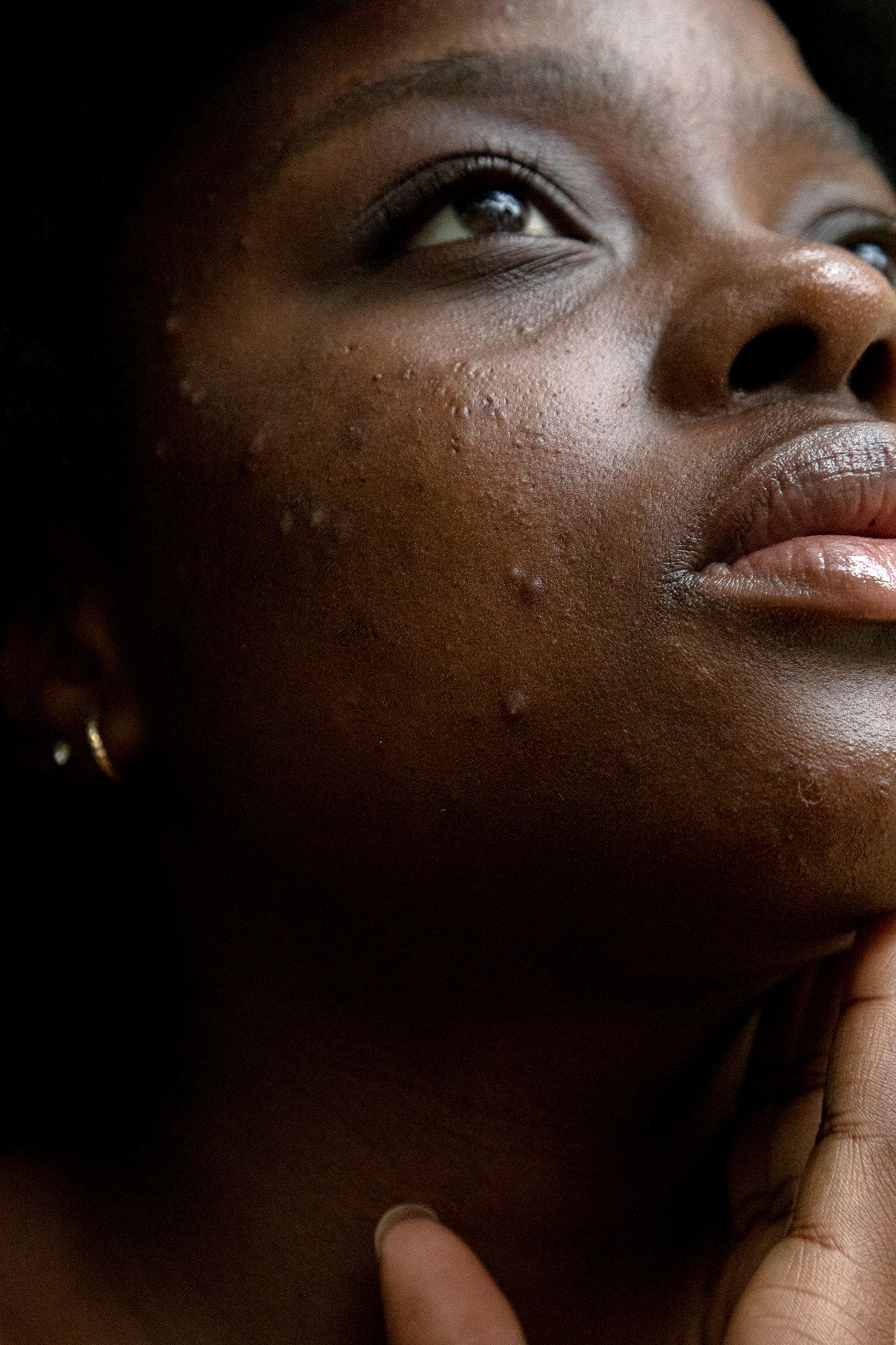 Rosacea In Dark Skin Symptoms, Expert Advice