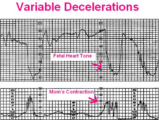 Early, Variable, and Late Decelerations