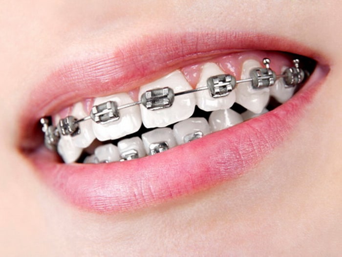 Caring for Your Teeth When Wearing Braces RegularLink