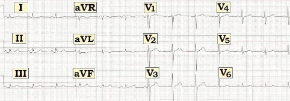 ECG Review Nothing More than Nonspecific Changes? 20110615 AHC