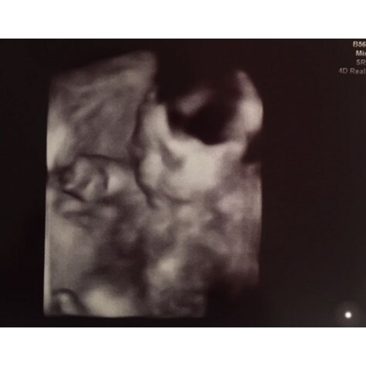 Uterine wall of fame (IVF success stories) Remembryo