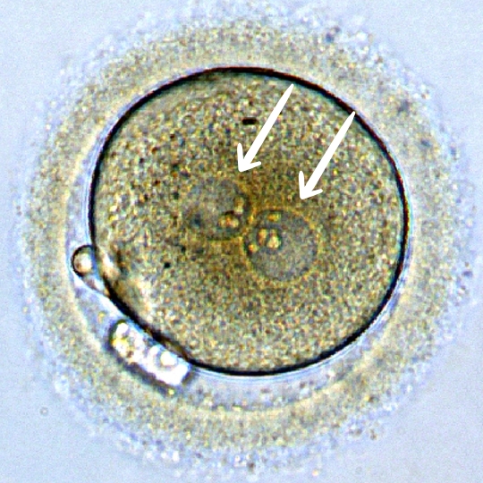 First report of a healthy birth from an "abnormally fertilized" 4PN