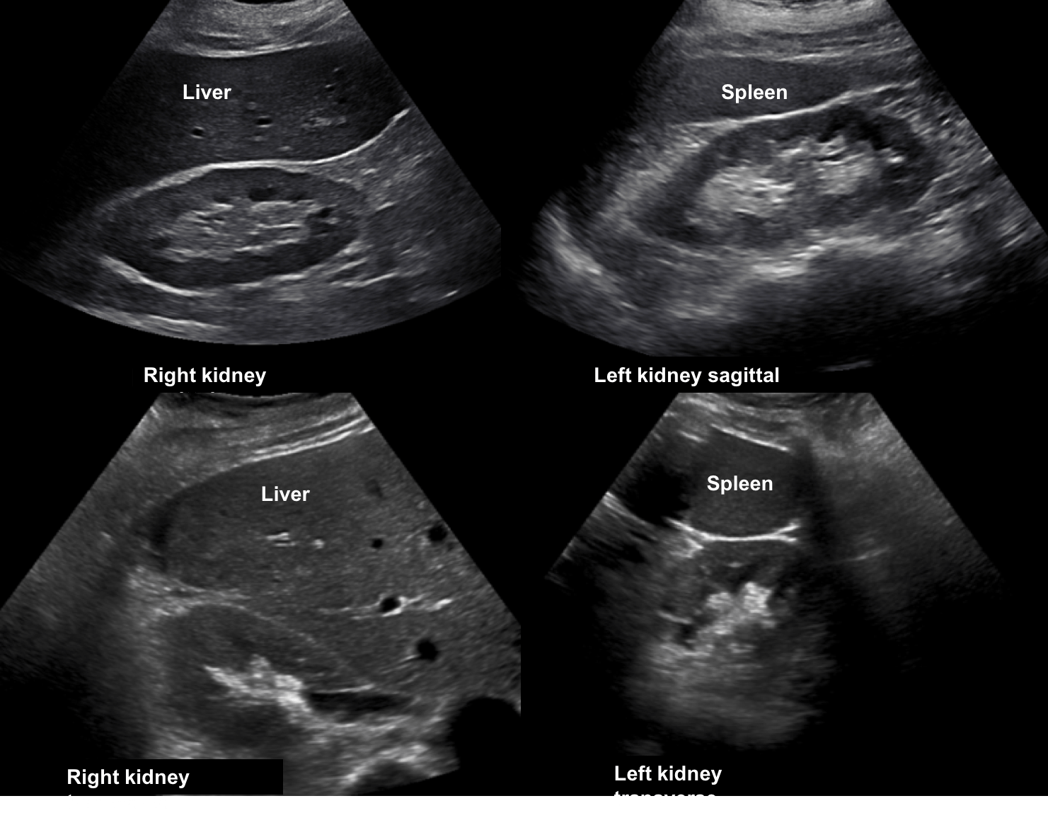 Renal Pyramids Ultrasound