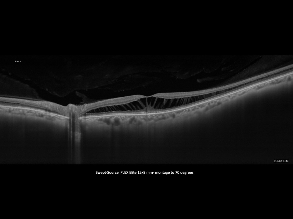 Case 61 Range of Retinoschisis Revisited Page 28 of 47 Retina