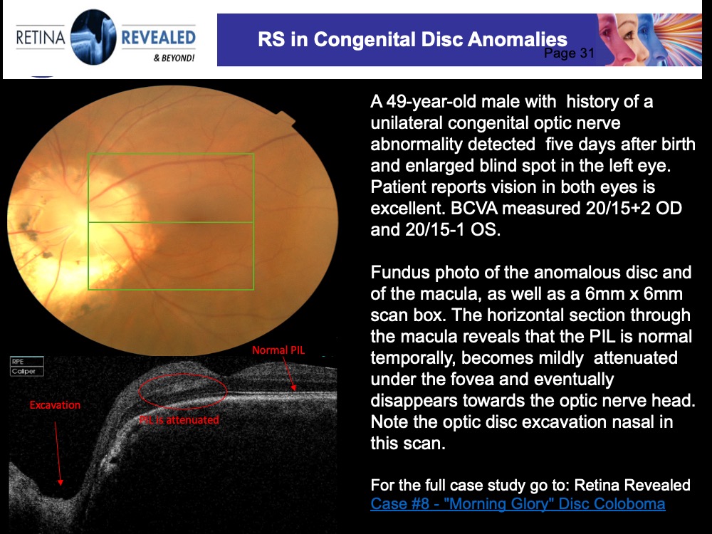 Case 61 Range of Retinoschisis Revisited Page 6 of 47 Retina
