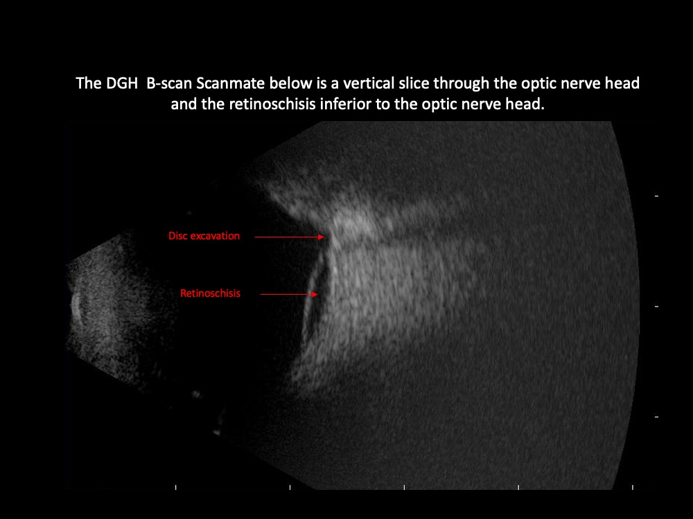 Case 61 Range of Retinoschisis Revisited Page 9 of 47 Retina