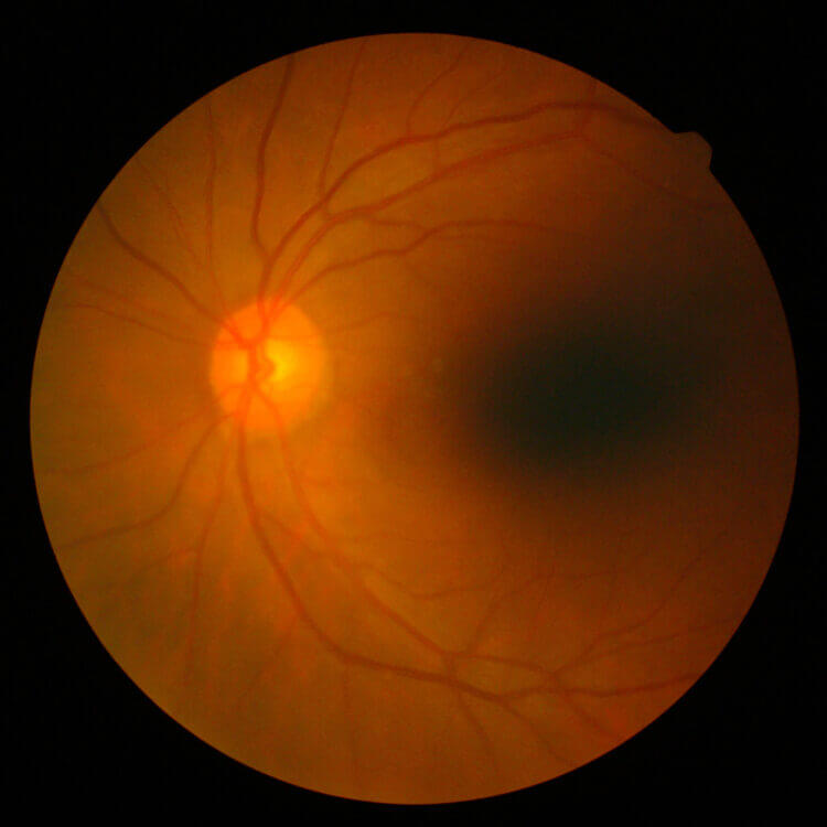 Retinal Detachments Retina Consultants Of Michigan
