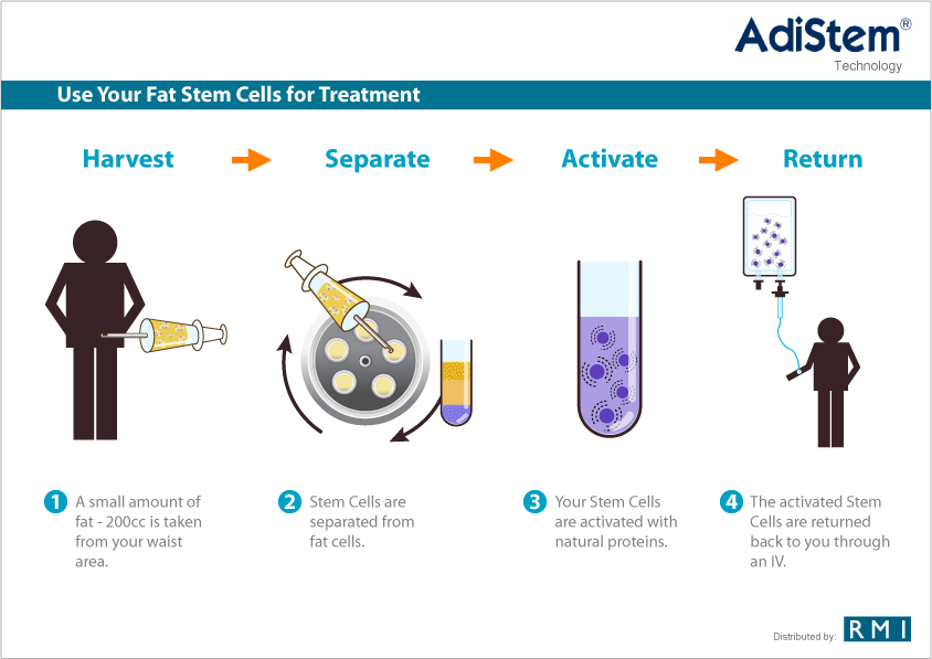 Treatment for Hair Restoration Stem Cell Therapy for Hair Restoration