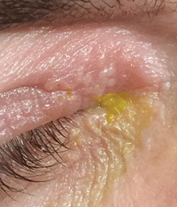 Cold Sore, Hot Lid