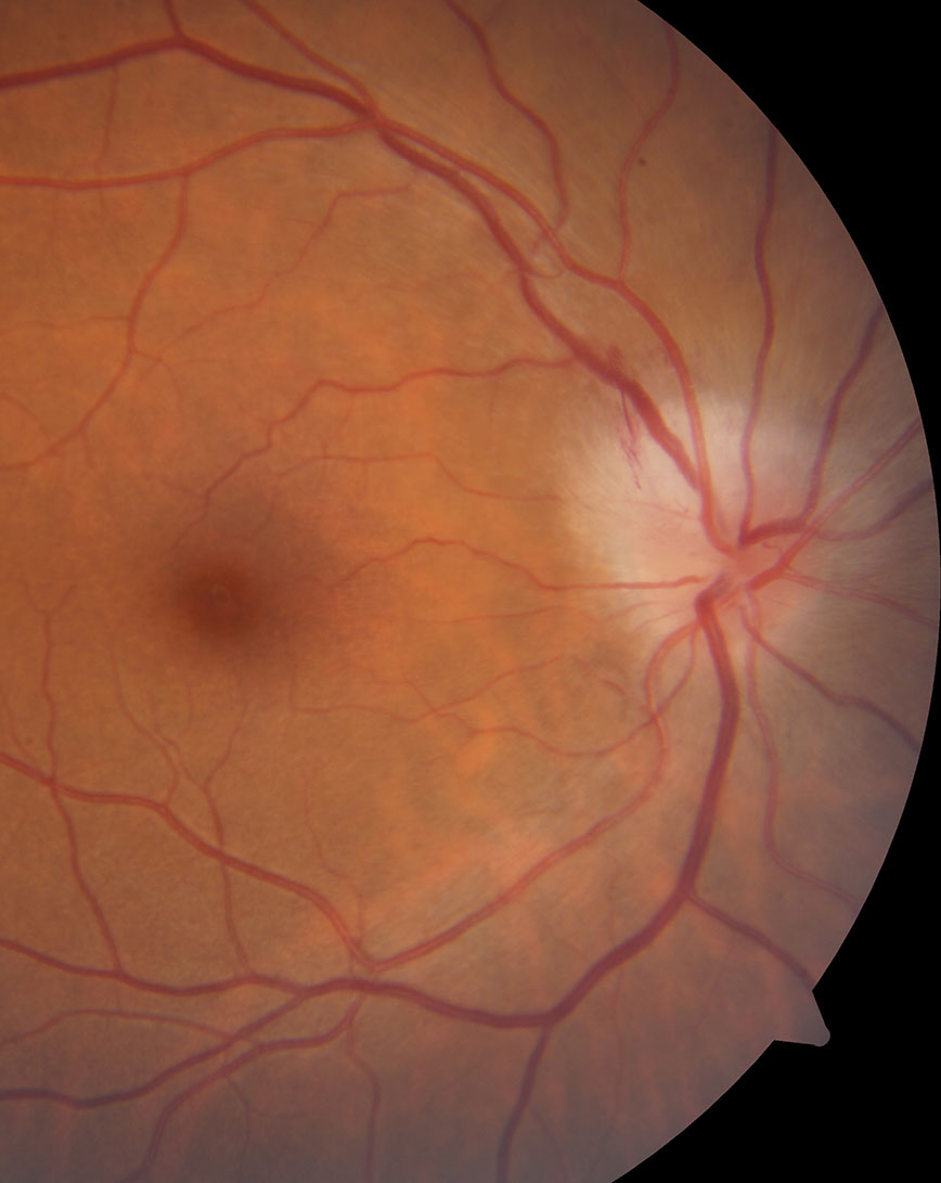 An Optic Neuritis Outlier