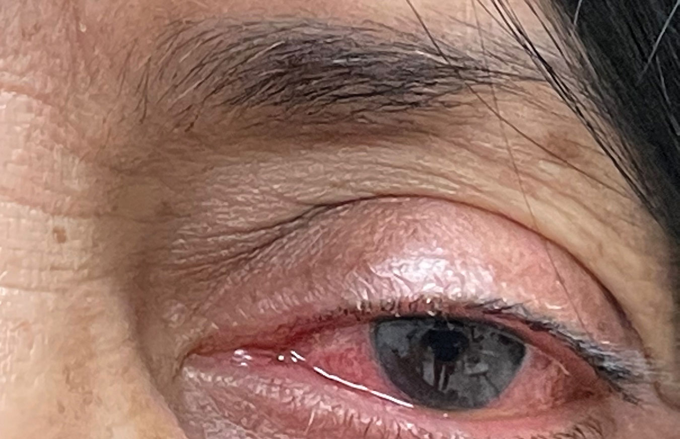 Using Antibiotics in Anterior Segment Care