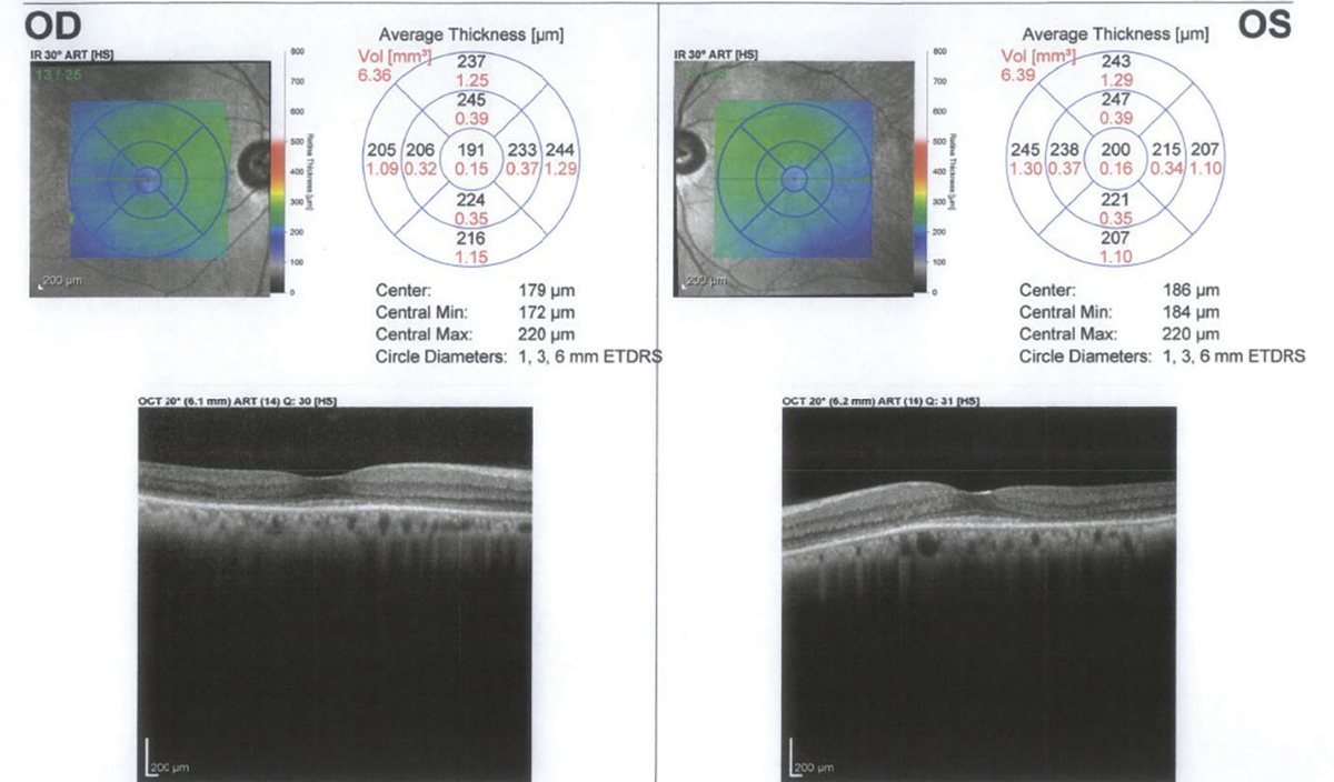 Plaquenil Toxicity How to Avoid this Bullseye