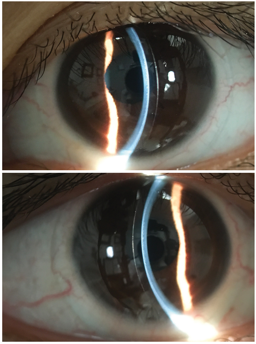 Trends, Challenges and Controversies in Keratoconus