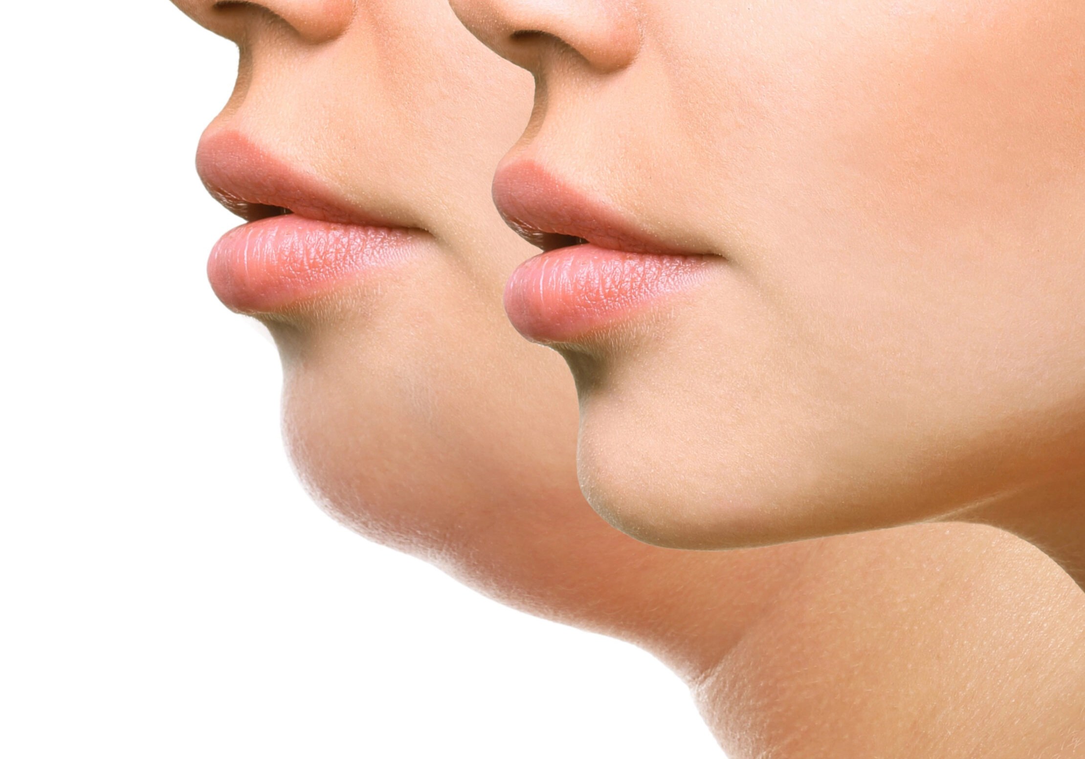 Say goodbye to your double chin! Revital Lab Surrey Clinic