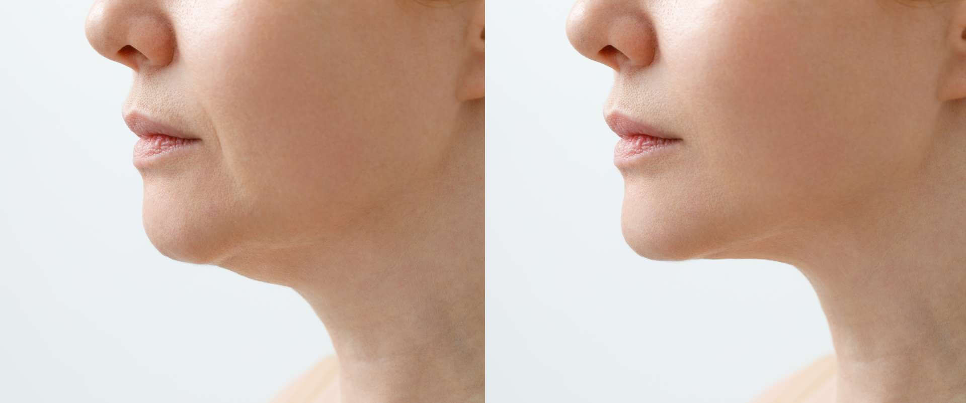Understanding and Treating the Appearance of Jowls Reviva Labs