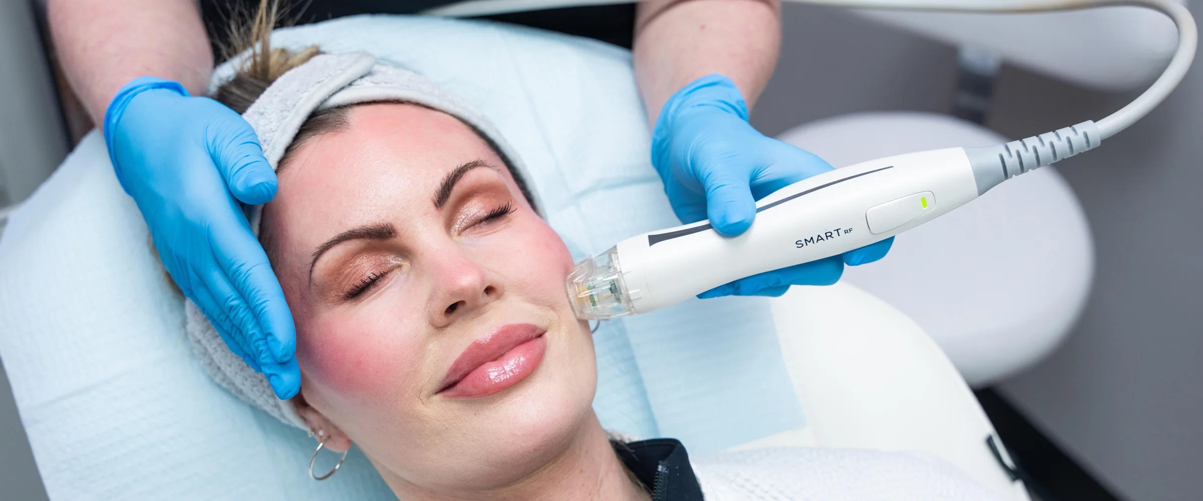 Microneedling In Detroit & Farmington Hills, MI Revive Med Spa