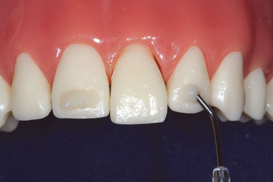 Trauma Stabilization Clinical Applications Ribbond