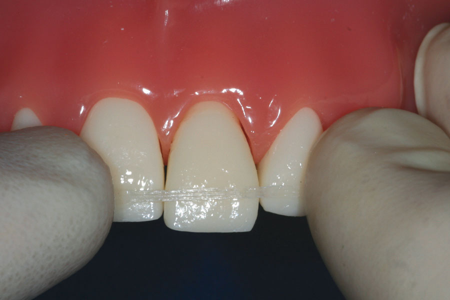 Trauma Stabilization Clinical Applications Ribbond