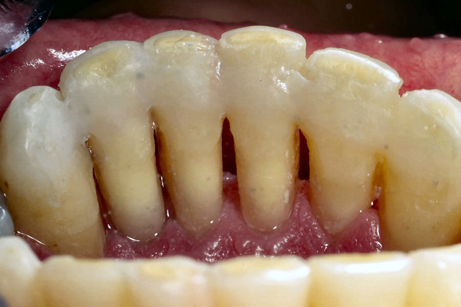Ribbond Férula Periodontal