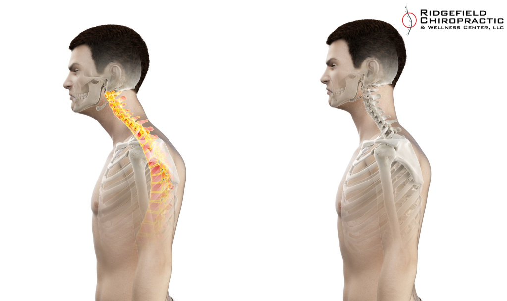How To Dismiss Tech Neck in 6 Easy Steps Ridgefieldchiropractic