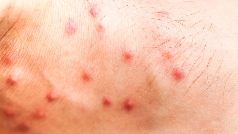What Bit Me?!? (Identifying Bug and Spider Bites)