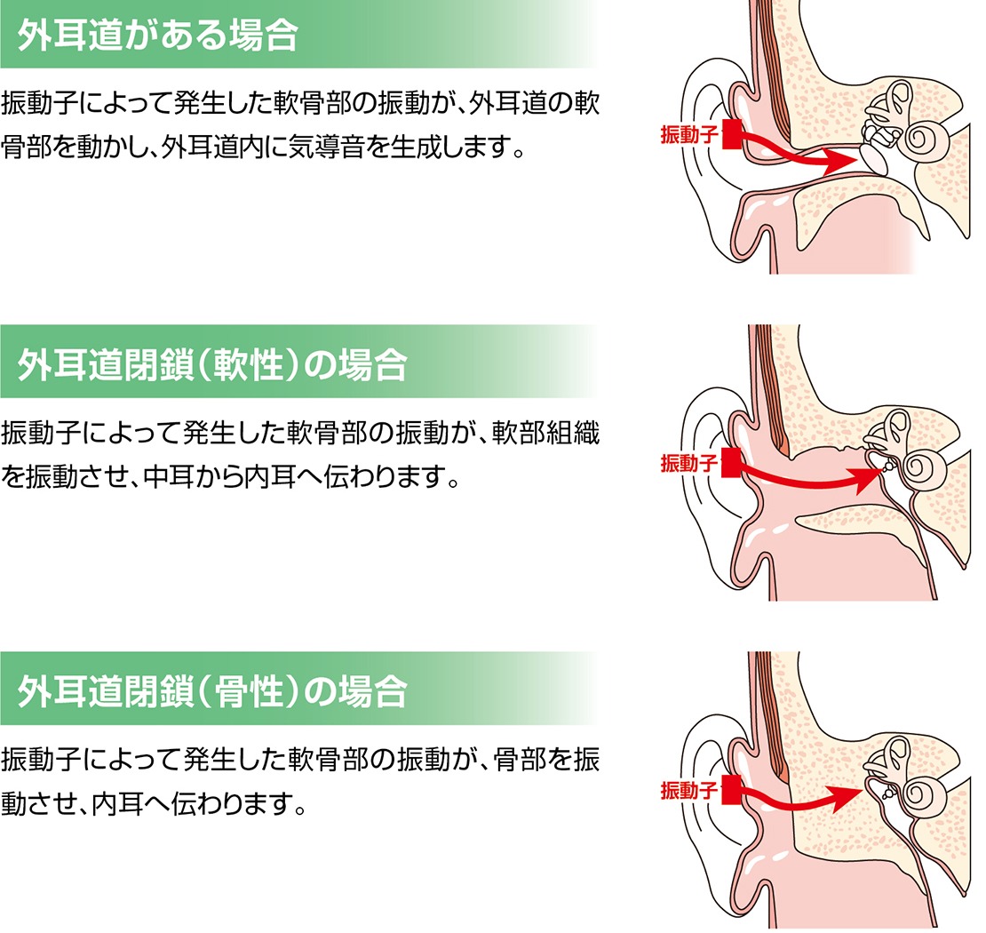 軟骨伝導補聴器