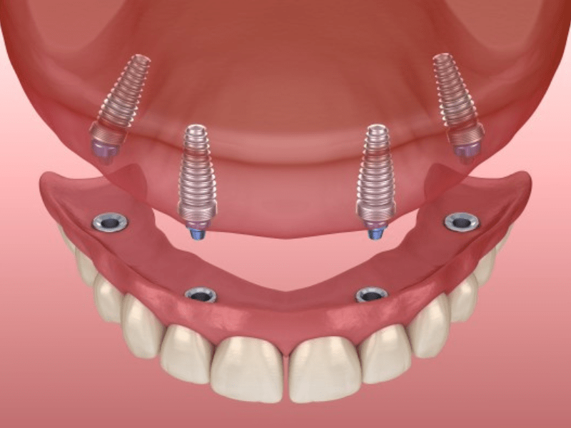 Snap On Dentures & Snap In Dentures Pros & Cons
