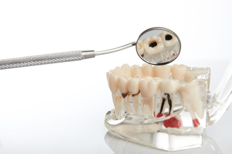 Dental jaw model with teeth, roots, gums, gum disease