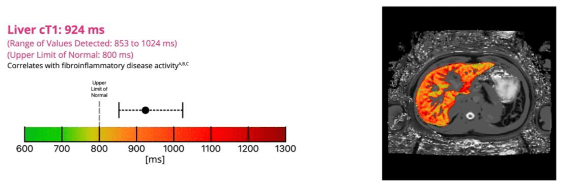 Measuring Iron in the Liver Dr. Gish