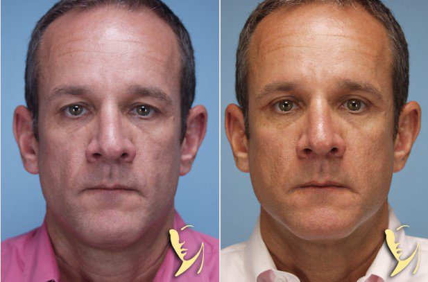 Upper Eyelid Before and After Gallery Atlanta, GA Dr. Burke Robinson