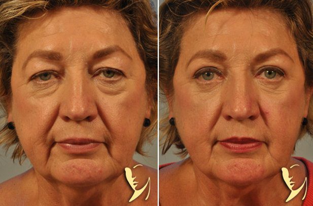 Lower Eyelid Before and After Gallery Atlanta, GA Dr. Burke Robinson