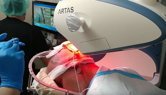 ARTAS Robotic Hair Restoration System Robotic Gizmos