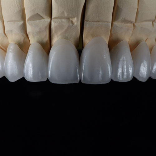 Combination work Emax Crowns and Veneers Crowns & Bridges