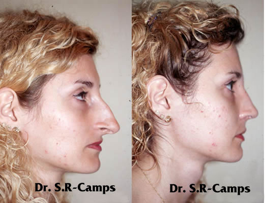 Rinoplastia Valencia