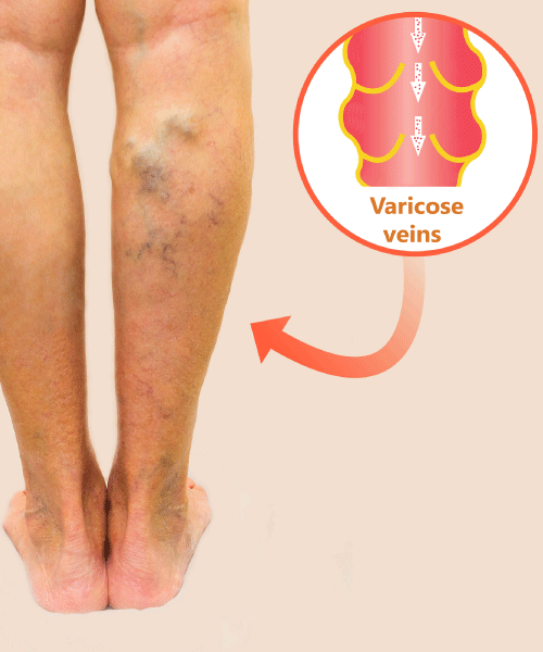 Varicose Veins Dr. Rohit Kumar