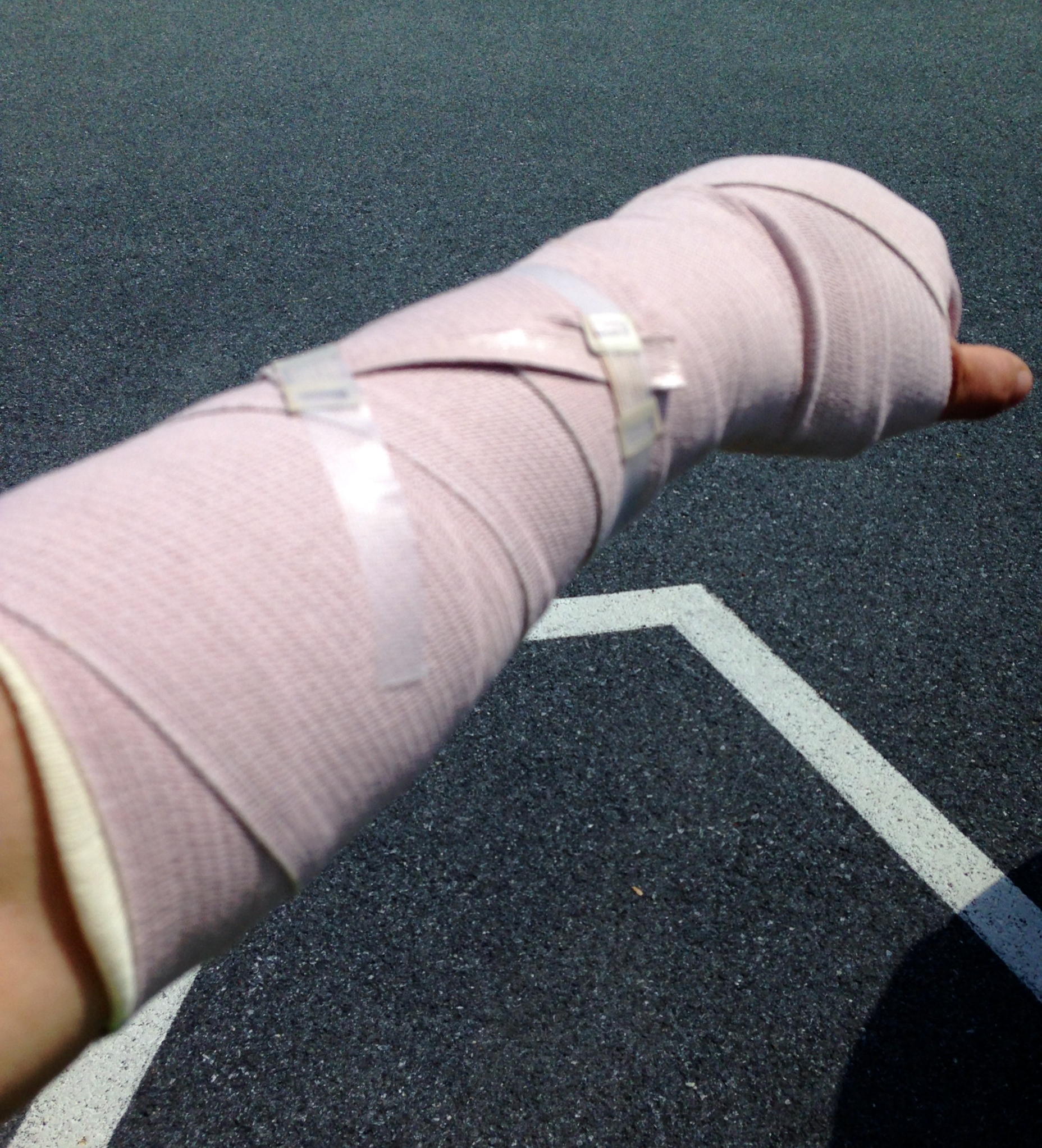 Broken hand…..