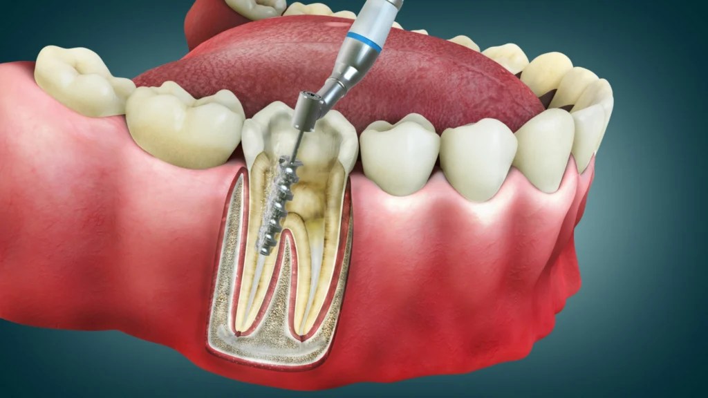 How long is a root canal procedure? Roots Dental