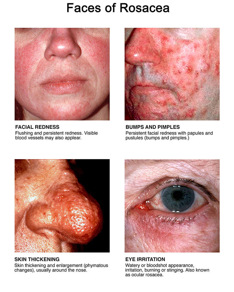 All About Rosacea | Rosacea.org