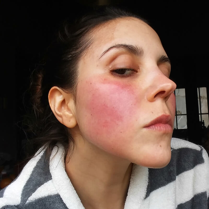 Persistent Facial Redness is the Most Common and Bothersome Sign of